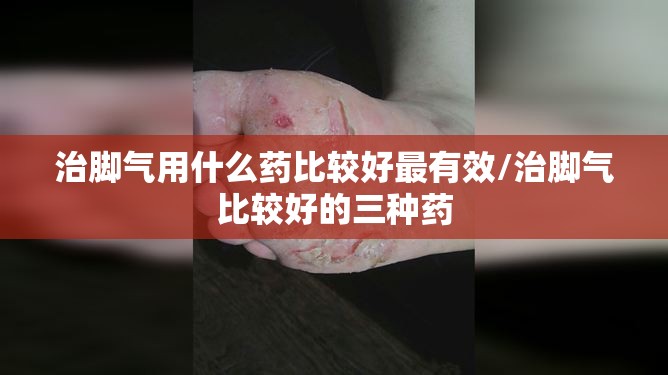 治脚气用什么药比较好最有效/治脚气比较好的三种药